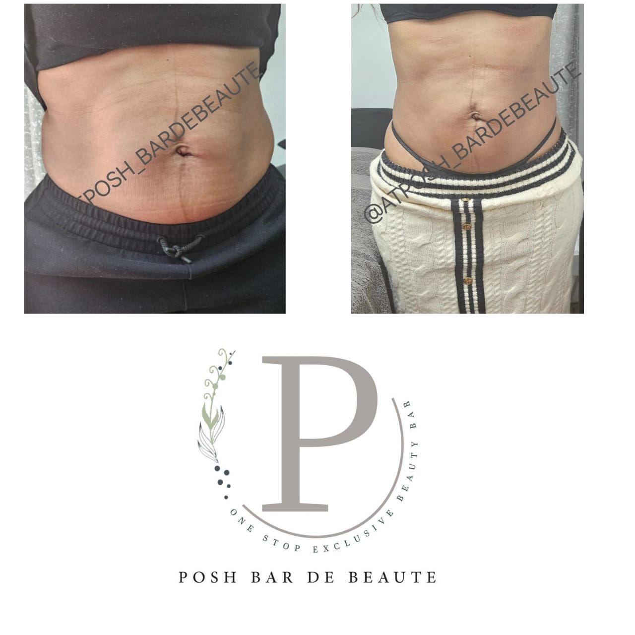 Beauty Boost & Injections