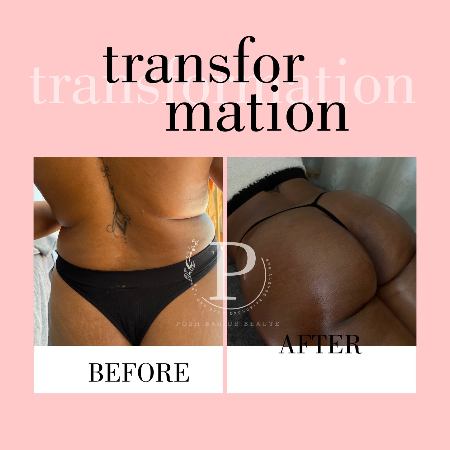 BUTT LIFT (8 Sessions)