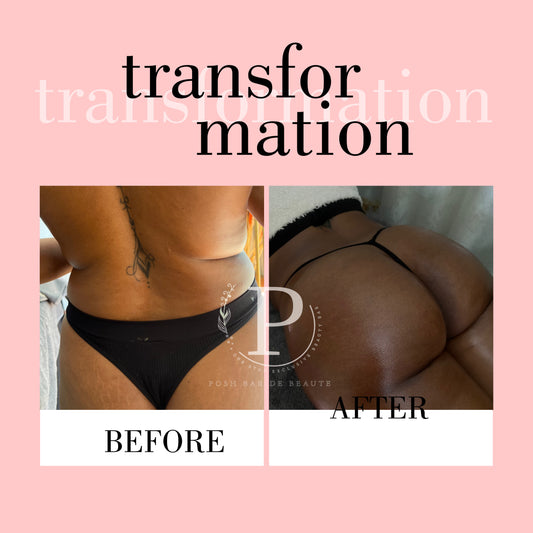 BUTT LIFT (8 Sessions)