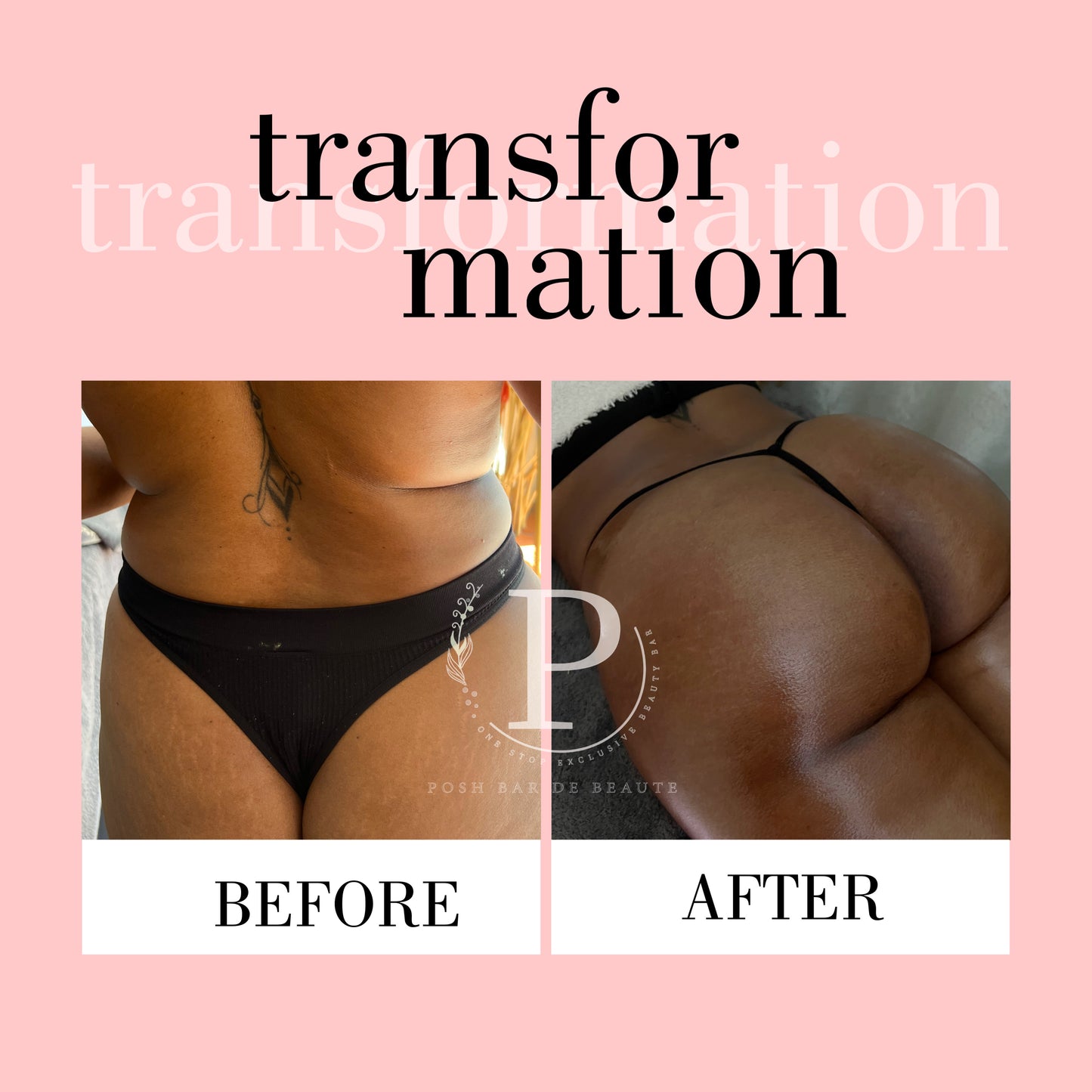 Butt-Lift (8 Sessions)