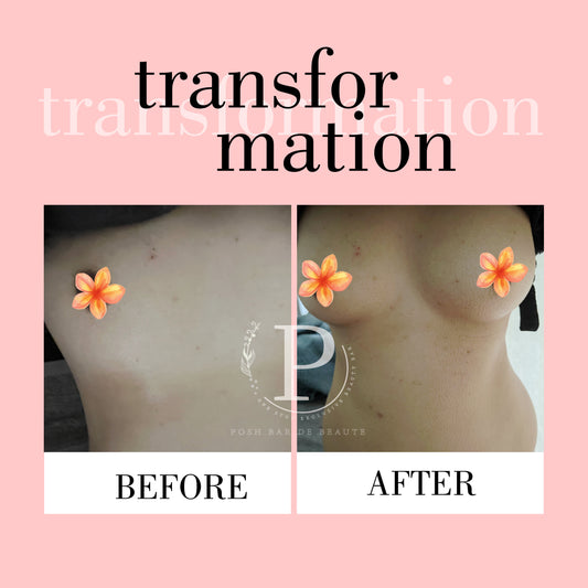 BREAST LIFT (8 Sessions)